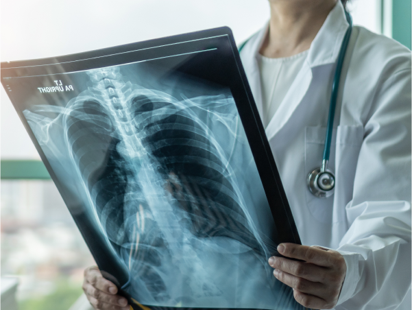 Medico che osserve una lastra ai polmoni