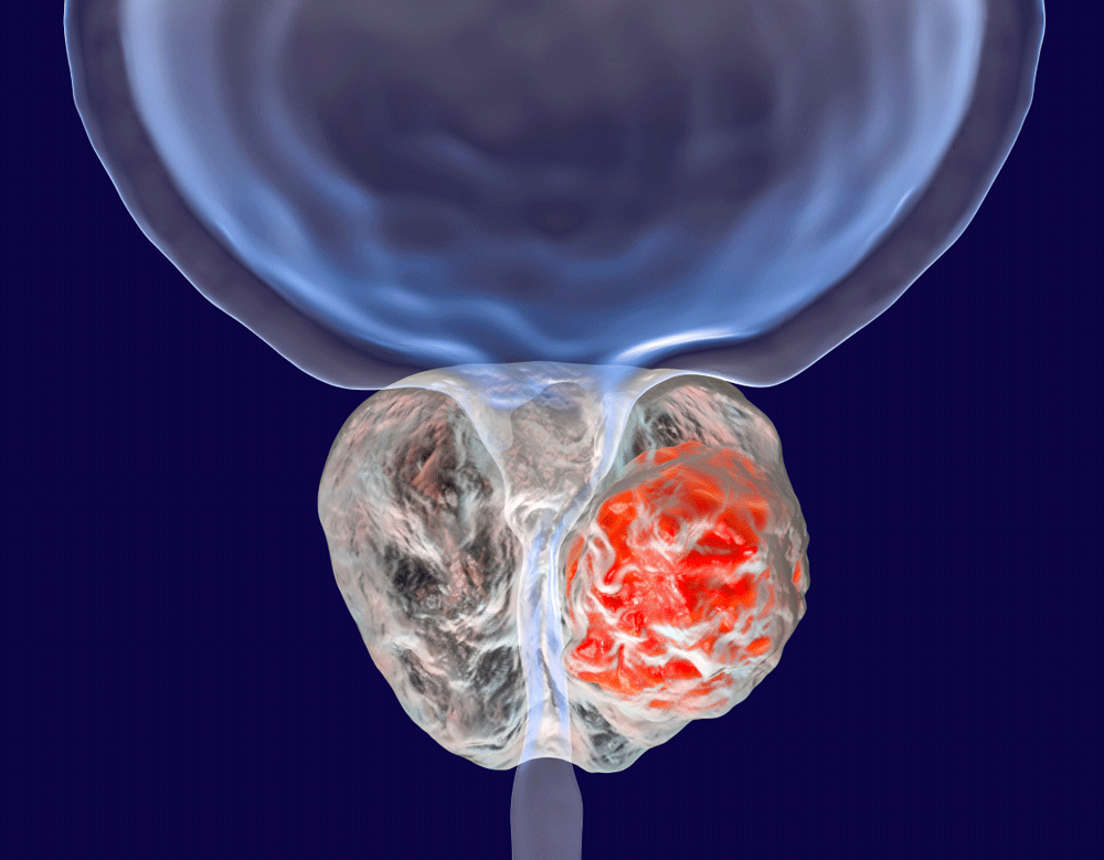 Immagine tumore alla prostata