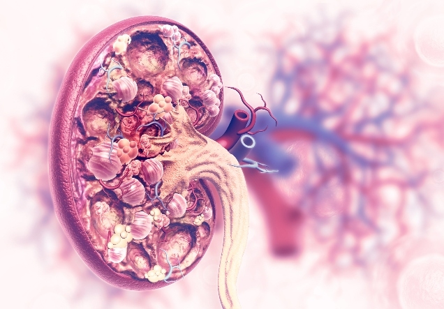 Immagine di rene affetto dalla patologia